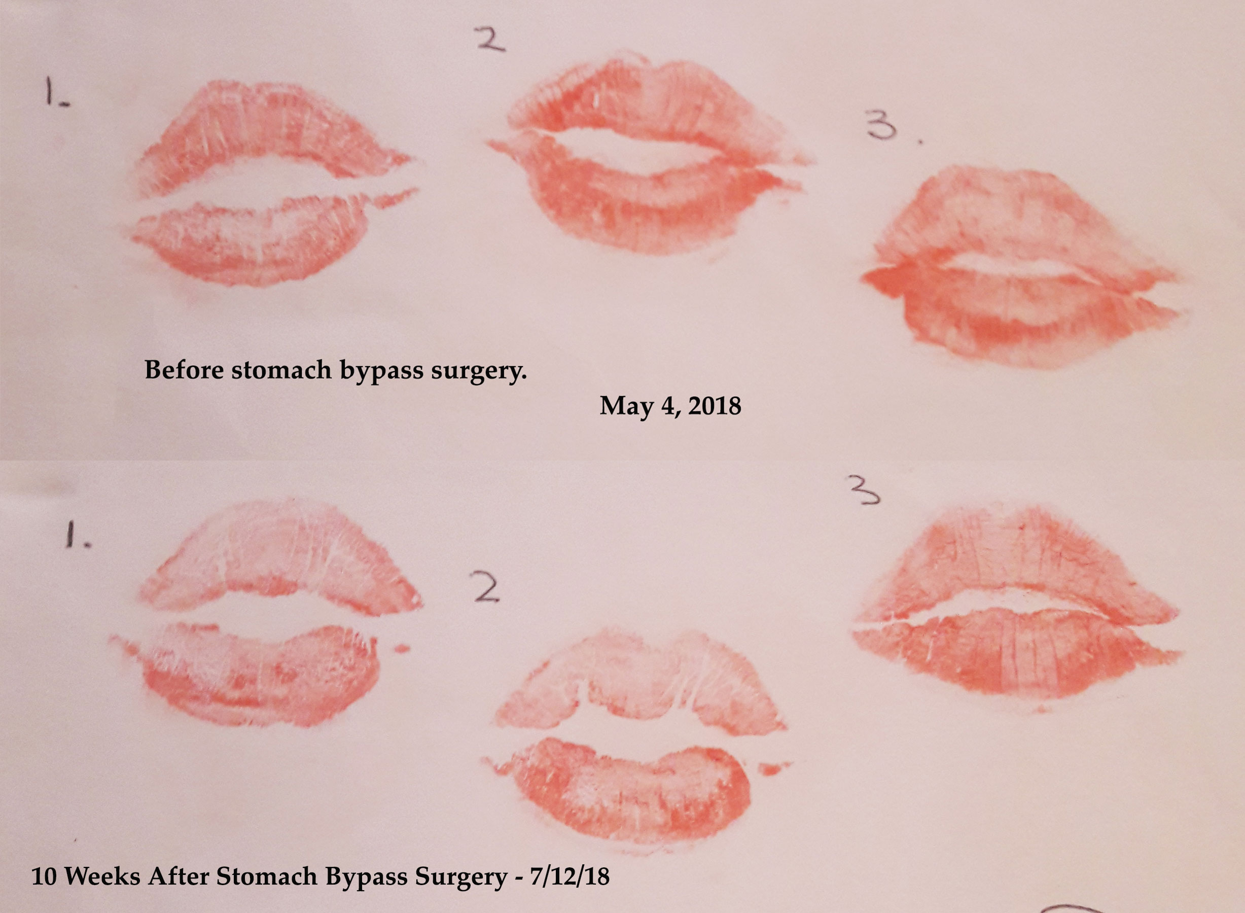 Before and After Bypass Surgery